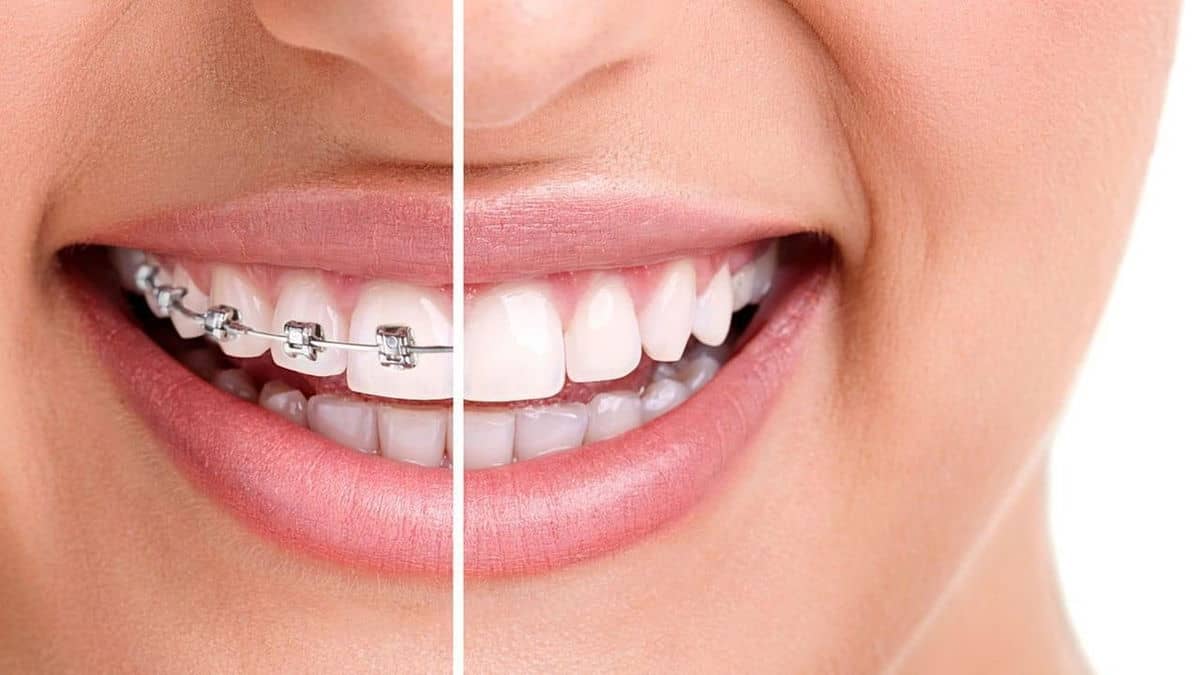 Braces and clear aligner orthodontic treatment