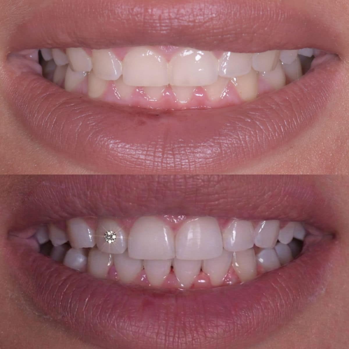 Caso reale della Belvedere Clinic — sbiancamento dentale con Twinkle, prima e dopo