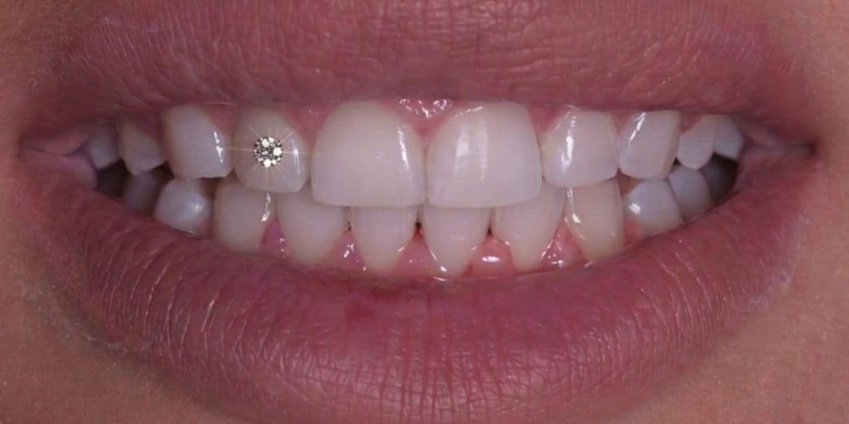 Un Twinkle — piccola gemma dentale applicata su un dente anteriore alla Belvedere Clinic